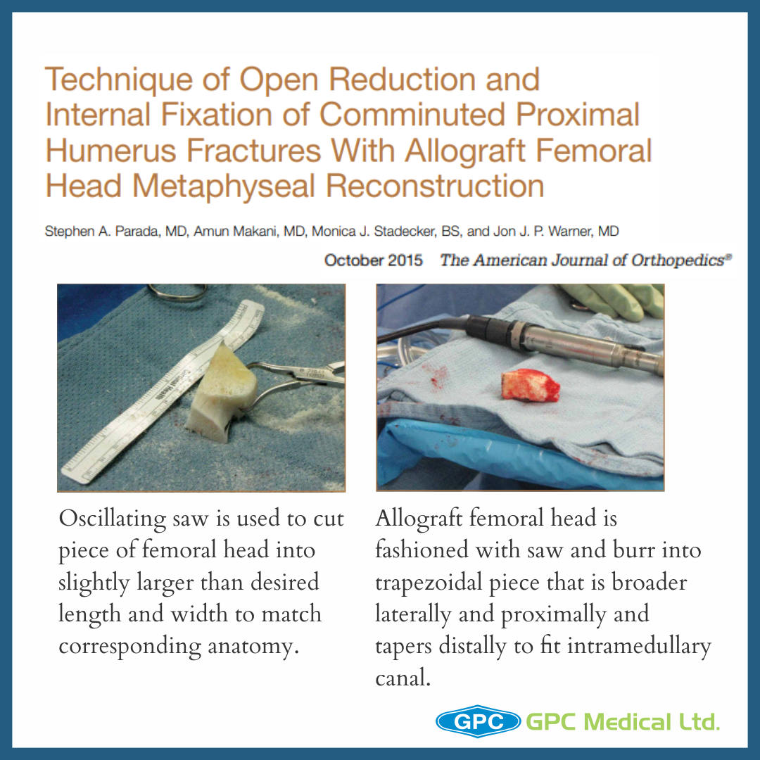 Anatomic evaluation of radiographic landmarks for accurate straight  antegrade intramedullary nail placement in the humerus